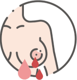 Núm vú tiết dịch bất thường